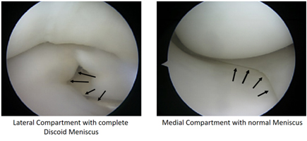 Knee Pain/Clicking from a Symptomatic Discoid Lateral Meniscus