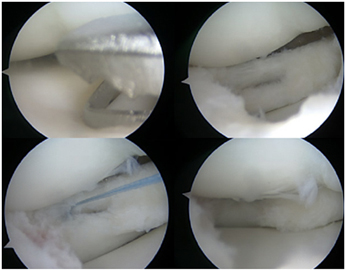 Knee Pain/Clicking from a Symptomatic Discoid Lateral Meniscus