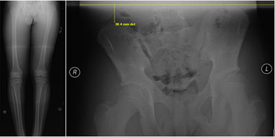 Lower Extremity Limb Length Inequality