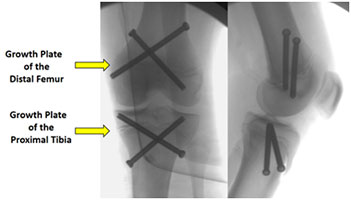 Lower Extremity Limb Length Inequality