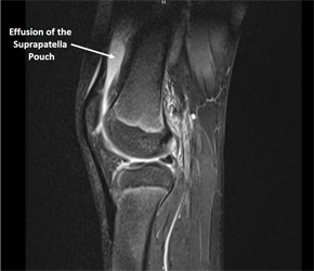 Lyme Arthritis of the Knee Mimicking Septic Arthritis