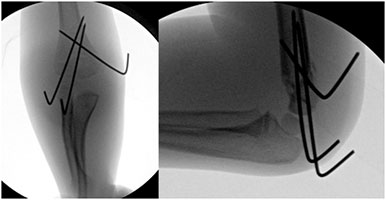 Monkey Bars Fall Elbow Fracture