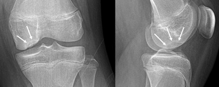 Osteochondritis Dissecans of the Knee