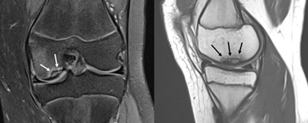 Osteochondritis Dissecans of the Knee