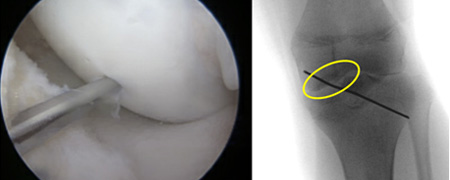 Osteochondritis Dissecans of the Knee