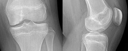 Osteochondritis Dissecans of the Knee