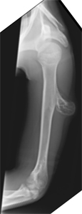 Osteochondroma of Left Arm