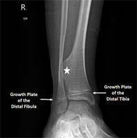 Osteochondroma of the Ankle