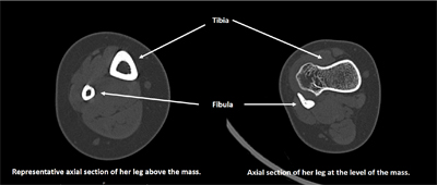 Osteochondroma of the Ankle