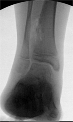 Osteochondroma of the Ankle