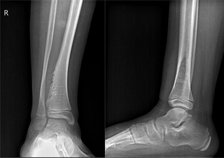 Osteochondroma of the Ankle