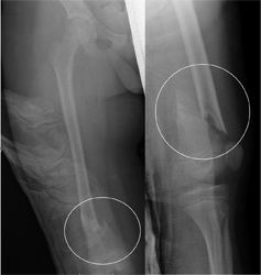 Pathological Femur Fracture