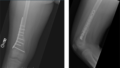 Pathological Femur Fracture