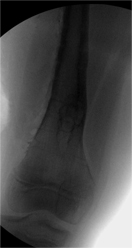 Pathological Femur Fracture