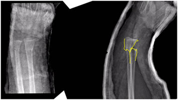 Did You Know that Pediatric Bones Can Remodel After a Fracture?