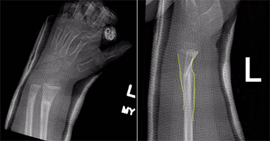 Did You Know that Pediatric Bones Can Remodel After a Fracture?