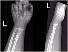 Did You Know that Pediatric Bones Can Remodel After a Fracture?