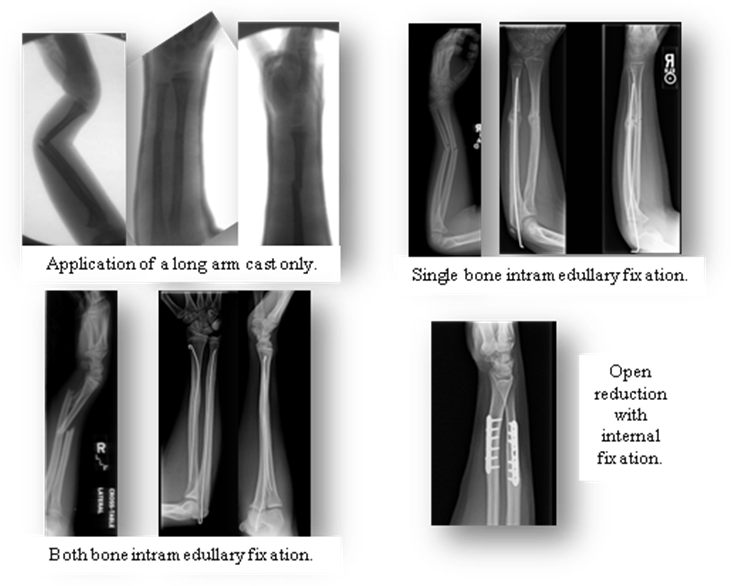 Pediatric Both Bone Forearm Fractures