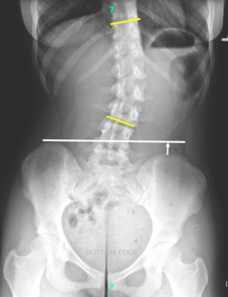 Pediatric Spinal Conditions