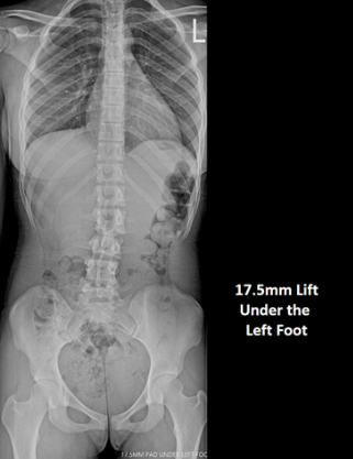 Pediatric Spinal Conditions