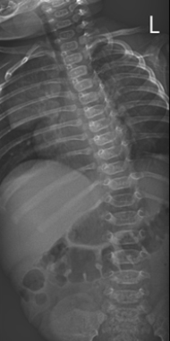 Pediatric Spinal Conditions