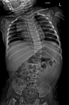 Pediatric Spinal Conditions