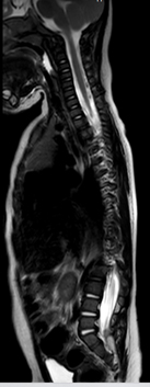 Pediatric Spinal Conditions