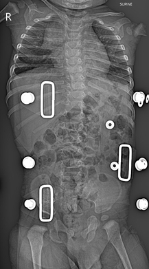 Pediatric Spinal Conditions