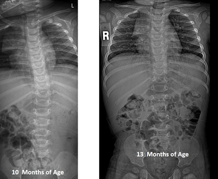 Pediatric Spinal Conditions