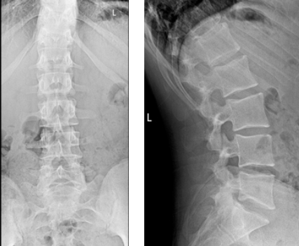 Pediatric Spinal Conditions