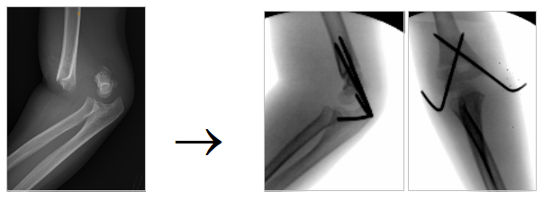 Pediatric Supracondylar Humerus Fractures