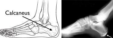 Sever's Calcaneal Apophysitis