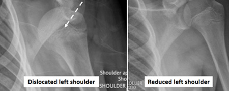 Shoulder Dislocation