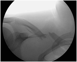 Snowboarding Clavicle Fracture