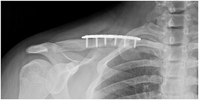 Snowboarding Clavicle Fracture