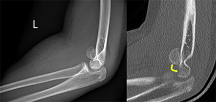 Soccer Elbow Fracture