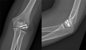 Soccer Elbow Fracture