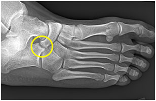 Tarsal Coalition Causing Chronic Foot/Ankle Pain