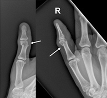 Thumb Fracture