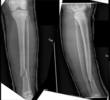 Tibia Fracture