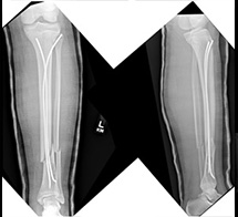 Tibia Fracture