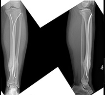 Tibia Fracture