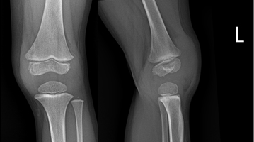 Toddler with Rheumatoid Arthritis of the Knee