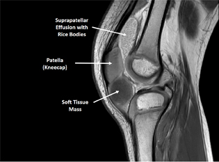 Toddler with Rheumatoid Arthritis of the Knee