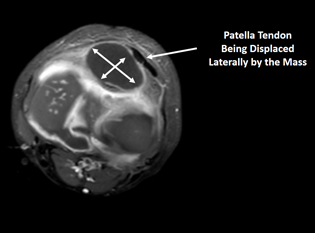 Toddler with Rheumatoid Arthritis of the Knee