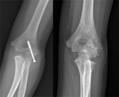 Trampoline Elbow Fracture