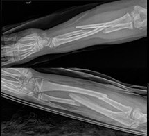 Trampoline Forearm Fractures