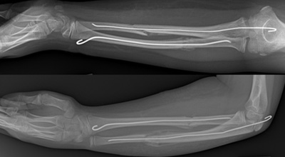 Trampoline Forearm Fractures