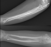 Trampoline Forearm Fractures