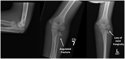 Wrestling Elbow Fracture